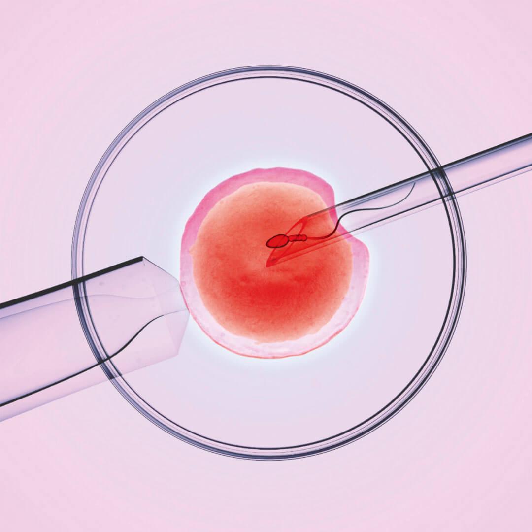 Искусственное оплодотворение